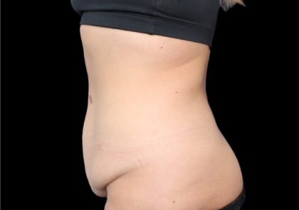 Tummy Tuck Before & After Patient #2498