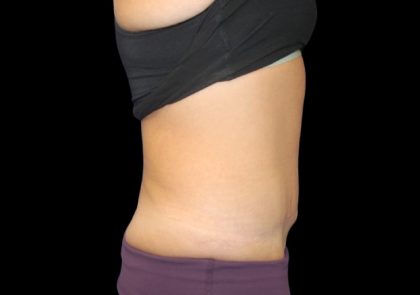 Tummy Tuck Before & After Patient #2498