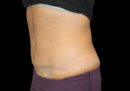 Tummy Tuck Before & After Patient #2498