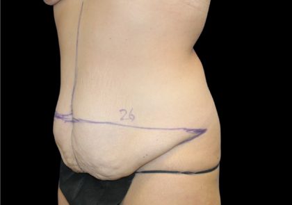 Tummy Tuck Before & After Patient #2498