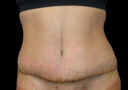 Tummy Tuck Before & After Patient #2498