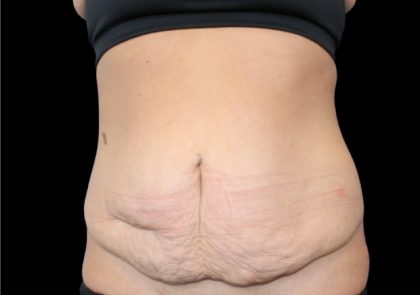 Tummy Tuck Before & After Patient #2498