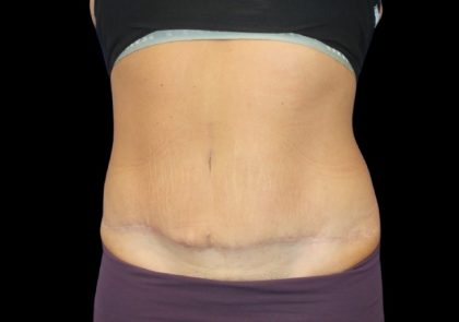 Tummy Tuck Before & After Patient #2498