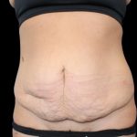 Tummy Tuck Before & After Patient #2498