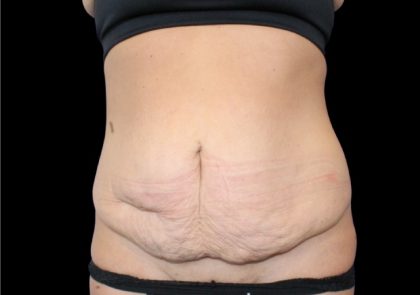 Tummy Tuck Before & After Patient #2498